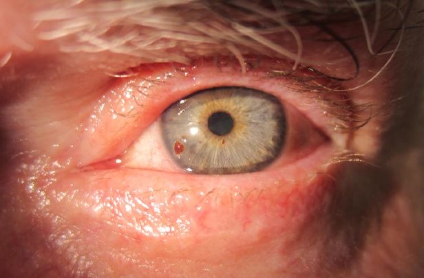 Foreign body on the cornea